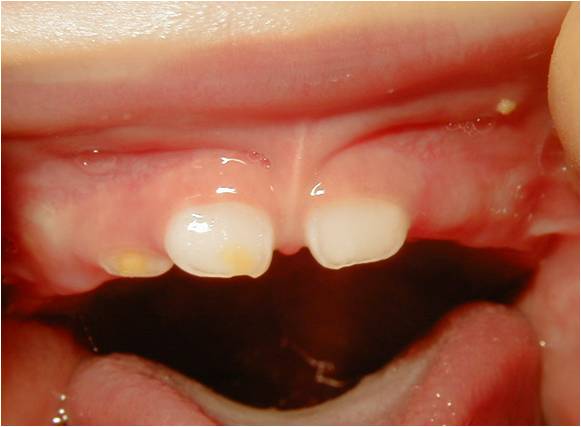 中括弧を付けている場合はどうなりますか?