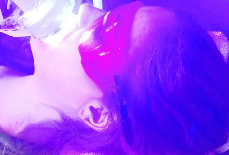 CoolBright-UltraEZy施術中の写真